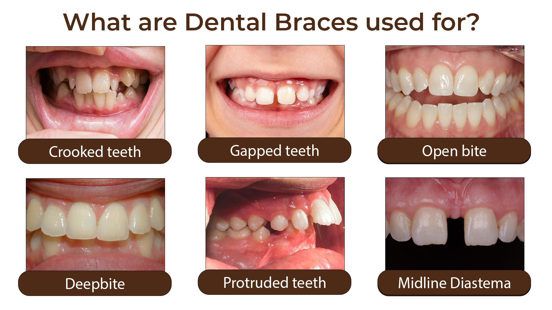 Dental Braces